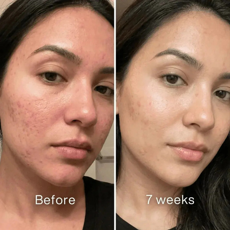 Acne Scar Repair Stick